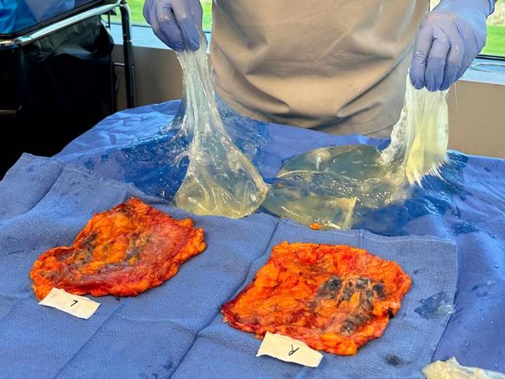 A photograph showing a person with gloved hands lifting two ruptured breast implants, one in each hand. The material from the implants appears sticky and stretches as it is lifted. The implants are in front of the person, on a surface covered in blue cloth. In front of the implants, on the same surface, are two scar tissue capsules labelled left and right.