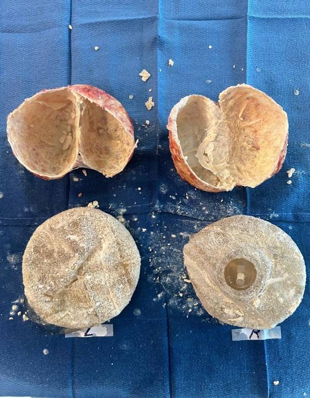 A photograph of two breast implants on a blue surface, with their corresponding scar capsules above them. The scar capsules are opened to show beige calcium deposits on the inner surface. The surface of both breast implants is also coated with a beige substance.