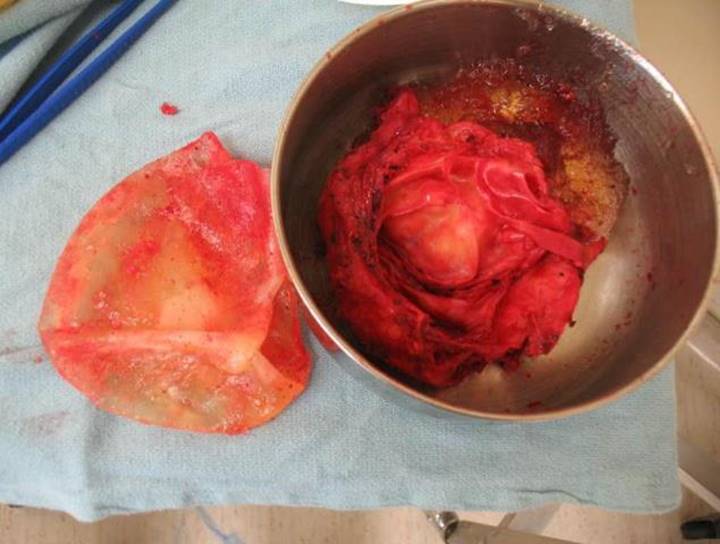 La photographie montre une masse rougeâtre dans un petit bol métallique. La masse semble entourée d’une capsule de tissu cicatriciel ayant été retirée et du gel provenant d’un implant mammaire. Une partie de l’implant mammaire est posé à côté du bol métallique.