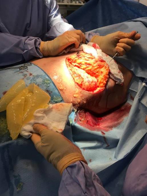 La photographie a été prise durant une chirurgie. La patiente gît sur une table d’opération avec le torse dénudé. Il y a une incision dans la peau là où se trouvait l’implant mammaire gauche. À l’aide d’outils chirurgicaux de métal, un chirurgien soulève le tissu sous l’implant mammaire gauche et expose ainsi le silicone qui s’est écoulé de l’implant mammaire pour se loger dans le corps. Une main à l’avant-plan tient de la gaze blanche sur le dessus de l’enveloppe restante de l’implant rompu.